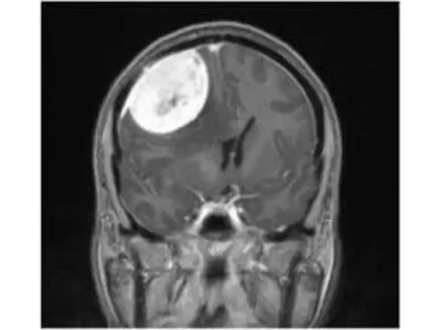 أورام الأم الجافية المحيطة بالمخ (Meningioma)