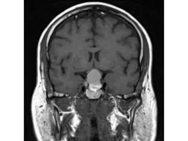 أورام الغدة النخامية (Pituitary Tumors)