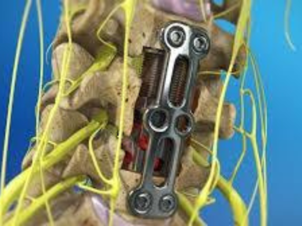 جراحات استبدال أجسام فقرات العمود الفقري وعمل تثبيت خلفي أو أمامي (Corpectomy)  