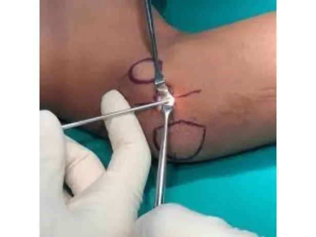 جراحات الأعصاب الطرفية لعلاج ضيق العصب الأوسط