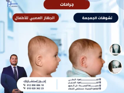 جراحات تشوهات الجمجمة والجهاز العصبي للأطفال