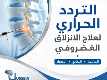 التردد الحراري لعلاج الانزلاق الغضروفي: الحالات والنتائج