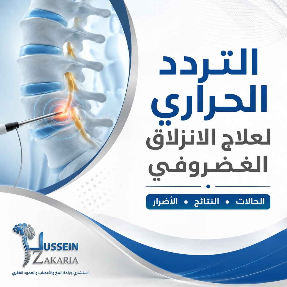 التردد الحراري لعلاج الانزلاق الغضروفي